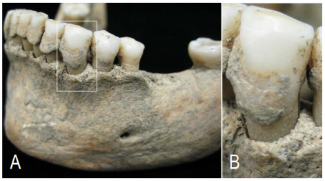 Şekil 3. (A) Bir Ortaçağ Avrupalısının çene kemiği, dişleri ve tartar, (B) soldaki resimdeki dikdörtgen içinde kalan dişin büyütülmüş hali. 