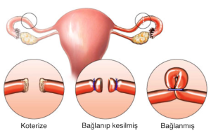 Kadınlarda yapılan fallop tüpü bağlama ameliyatı yöntemleri. 