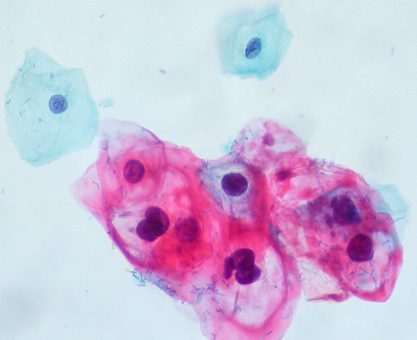 BİZİ KANSER YAPAN MİKROPLAR