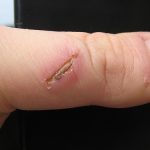 BİR YARA KABUĞUNUN HAYATI - 2