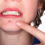 BİR SİVİLCENİN HAYATI