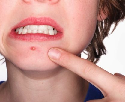 BİR SİVİLCENİN HAYATI