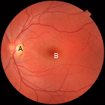 Gen tedavisi, görüşü geri kazandırabilir mi?